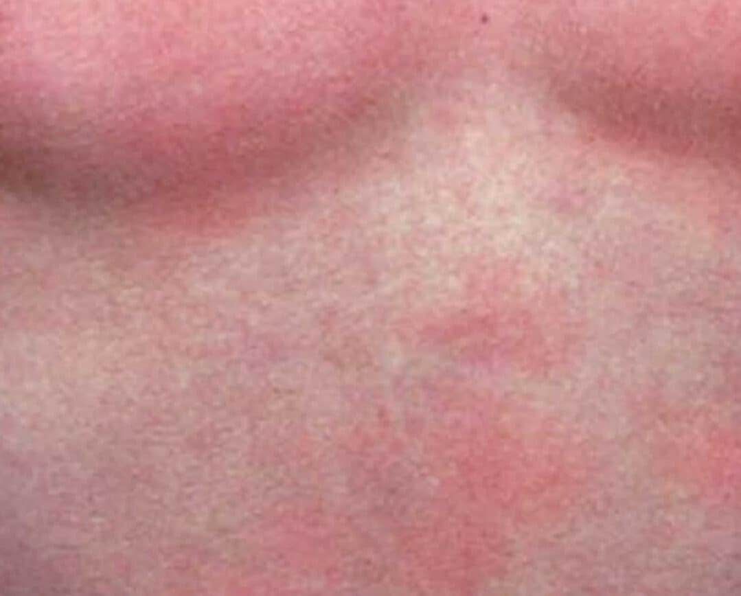 Heat Rash Underline Ring Rach Body armor heat rash - What is it and how to stop it.
